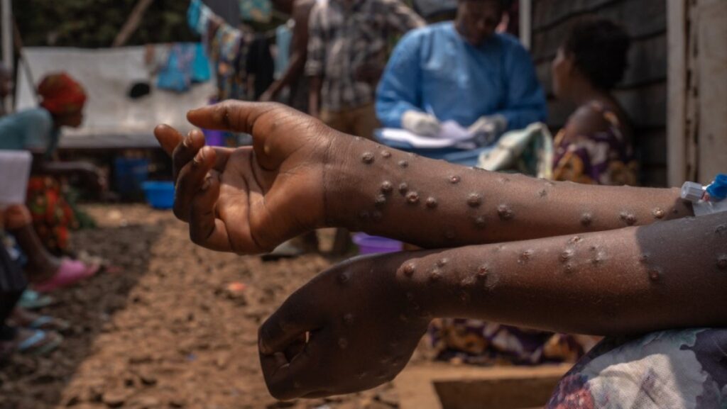 Negligencia por aumento de casos de mpox en África